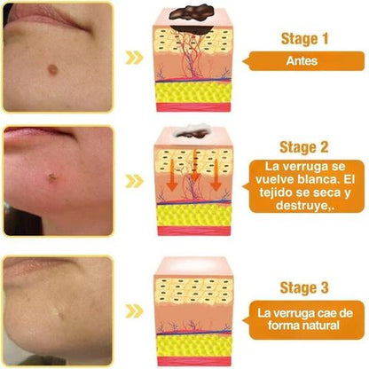 Spray Abeja Pura™ Elimina Marcas y Verrugas Fácil y Rápido