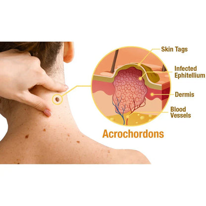 Spray Abeja Pura™ Elimina Marcas y Verrugas Fácil y Rápido